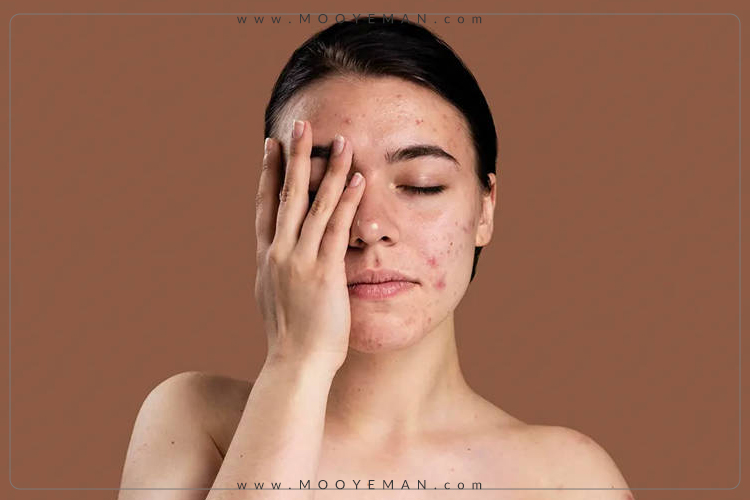 تاثیراسترس برپوست