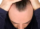 کارآیی آنزیم های آنتی اکسیدان در درمان ریزش مو