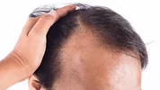 بررسی تاثیر سبک زندگی و عادات روزانه بر ریزش مو و راه های بهبود آن