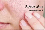 درمان منافذ باز پوست در خانه با چند روش تضمینی و موثر