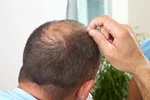 آیا کبد چرب باعث ریزش مو میشود؟
